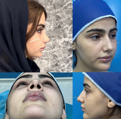 نمونه جدید جراحی بینی در تهران توسط دکتر علی شکرریز