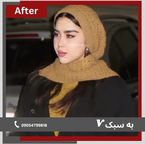 نتیجه جراحی بینی گوشتی با ظاهر متعادل و هماهنگ با اجزای صورت