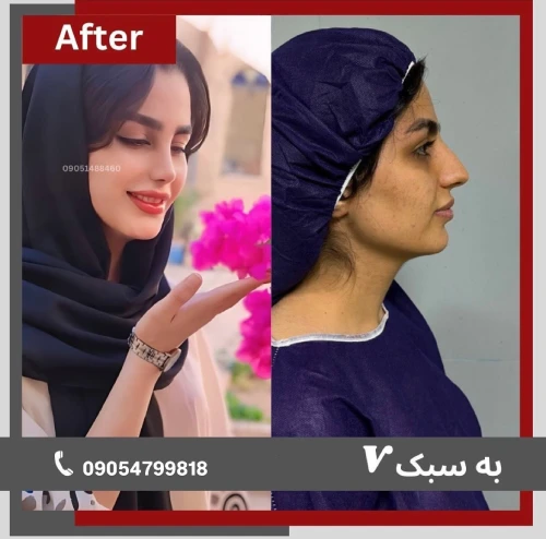 نمای روبه‌رو بینی گوشتی پس از جراحی با فرم طبیعی و متناسب با چهره