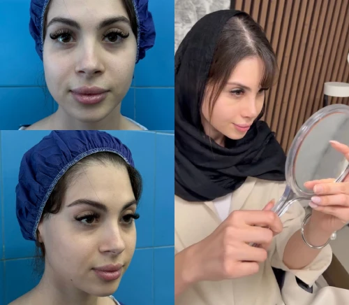 فرم نهایی بینی گوشتی پس از جراحی با حفظ زیبایی طبیعی و ساختار بینی