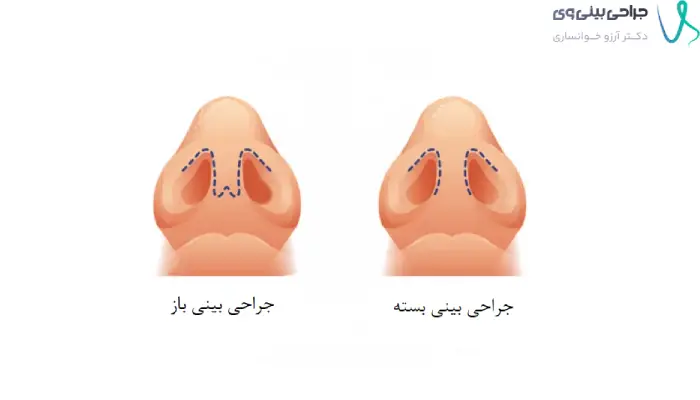 تفاوت محل برش در جراحی باز و بسته بینی