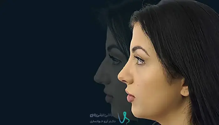 روند کاهش ورم و مشخص شدن نتیجه بینی نیمه فانتزی