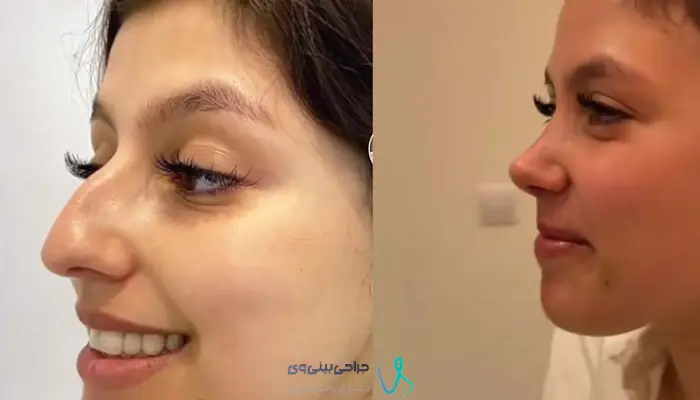 مراحل اصلاح قوز و فرم‌دهی استخوان بینی در جراحی