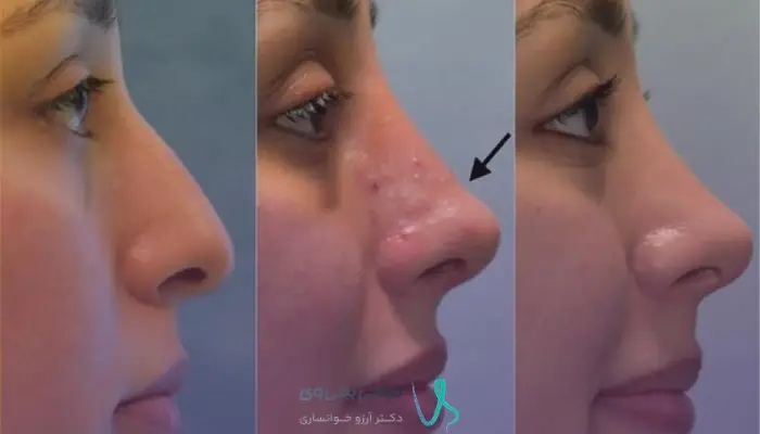 مراحل کاهش ورم و مشخص شدن نتیجه جراحی بینی طبیعی