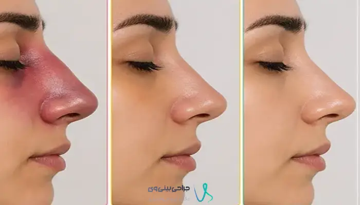 مراحل کاهش ورم و مشخص شدن فرم نهایی بینی استخوانی پس از عمل