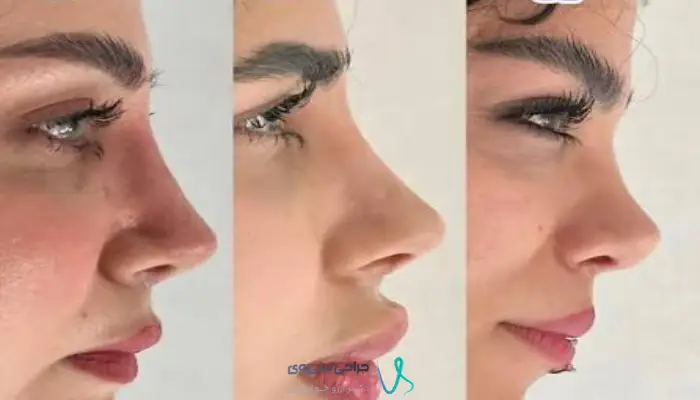 مقایسه بینی طبیعی نیمه فانتزی و فانتزی از دو نمای استاندارد