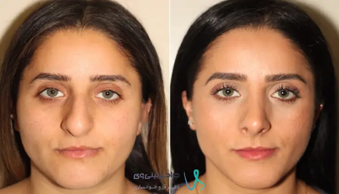 مقایسه ساختار بینی با پوست ضخیم و پوست نازک