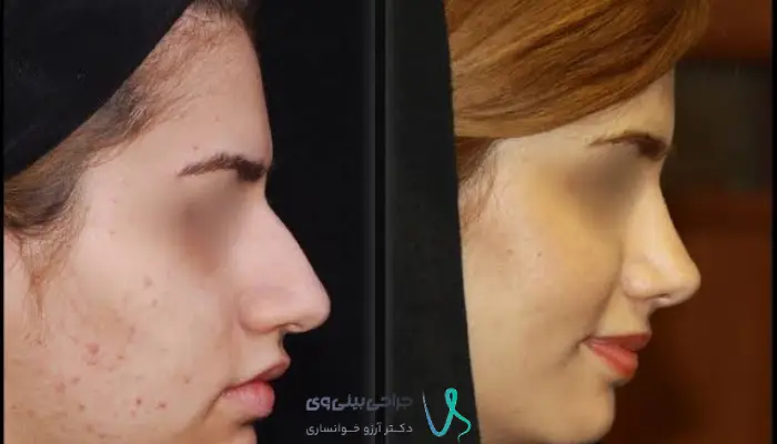 مقایسه مدل طبیعی و نیمه فانتزی برای بینی دارای پوست ضخیم