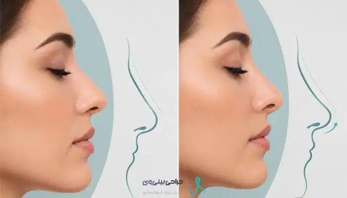 مقایسه نتیجه طبیعی و نیمه‌فانتزی عمل بینی استخوانی