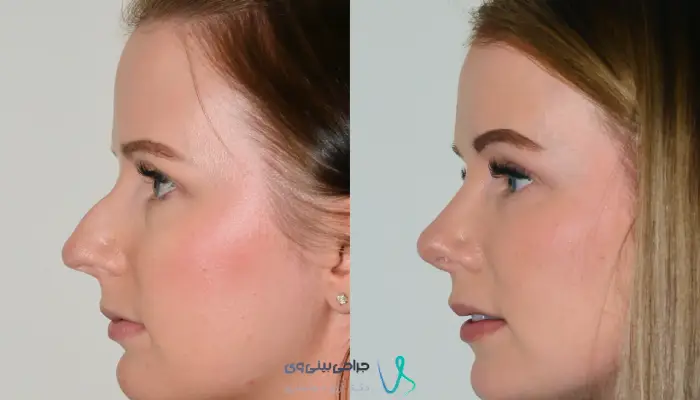 نتیجه طبیعی جراحی در بینی گوشتی و استخوانی