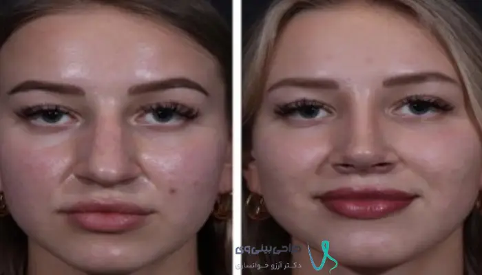 نماهای استاندارد قبل و بعد از جراحی بینی دارای پوست ضخیم