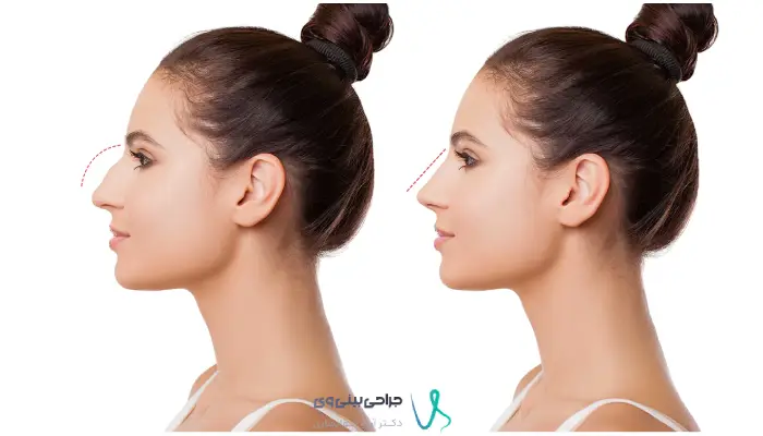 نمای نیم‌رخ بینی استخوانی دارای قوز پیش از جراحی