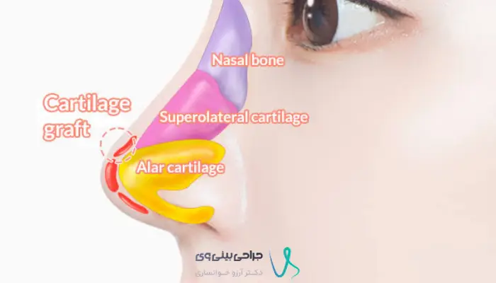 نمایش شماتیک تقویت غضروف نوک بینی در رینوپلاستی