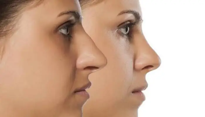 نمونه قبل و بعد جراحی بینی استخوانی با اصلاح قوز و حفظ تناسب چهره