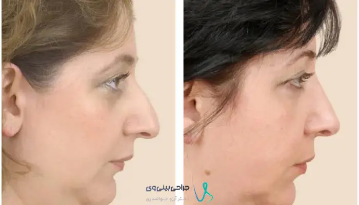 نمونه قبل و بعد جراحی بینی با حفظ فرم طبیعی چهره