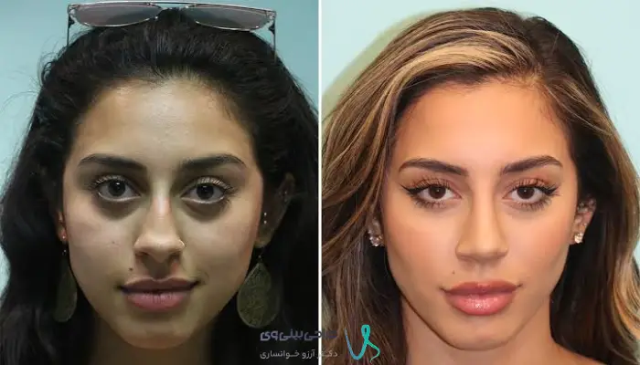 ویژگی‌های ظاهری بینی طبیعی در نمای روبه‌رو و نیم‌رخ