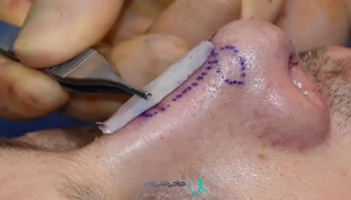 کاربرد پیوند غضروف در بازسازی و تقویت ساختار بینی
