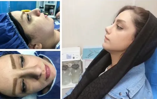نمونه‌کار جراحی بینی دکتر امیرحسین محمدی مفرد