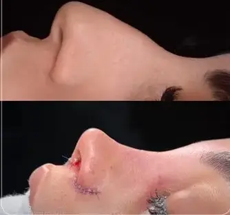 نمونه جراحی بینی دکتر امیرحسین محمدی مفرد