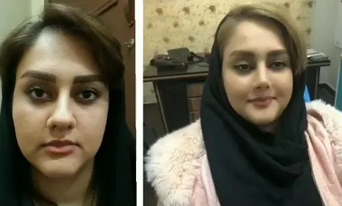 نمونه نتیجه جراحی بینی دکتر امیرحسین محمدی مفرد