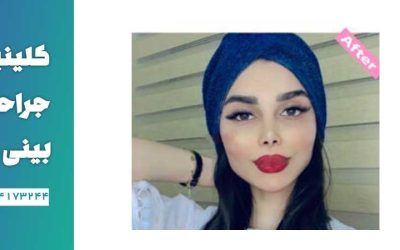 نمونه عمل بینی نیمه فانتزی