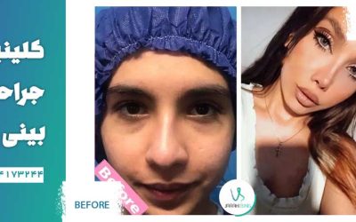 انواع عمل جراحی بینی