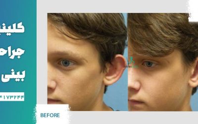 بهترین جراح اتوپلاستی در تهران