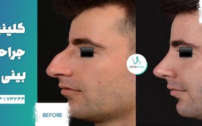 جراحیث بینی جقدر طول می کشد