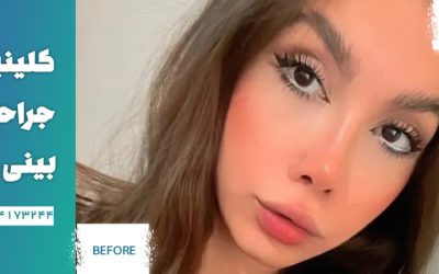 بهترین جراح بینی نیمه فانتزی در تهران