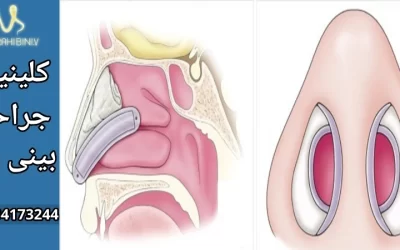 اسپیلنت بعد از جراحی بینی- دکتر آرزو خوانساری نیا