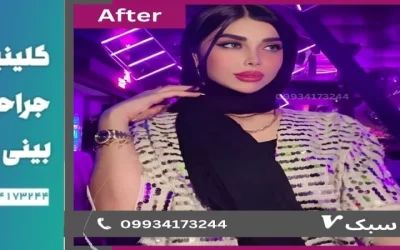 بهترین جراح بینی طبیعی در تهران- دکتر آرزو خوانساری (1)