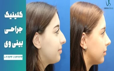 تاثیر جراحی بینی بر زیبایی چهره