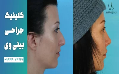 روش های اصلاح و رفع قوز بینی