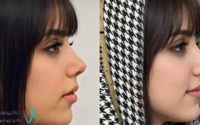 عکس قبل و بعد جراحی بینی