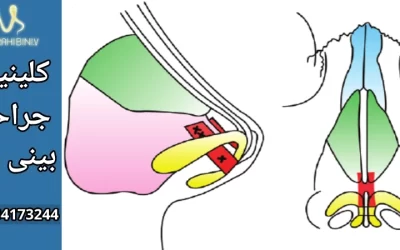 گرافت بینی- دکتر آرزو خوانساری نیا